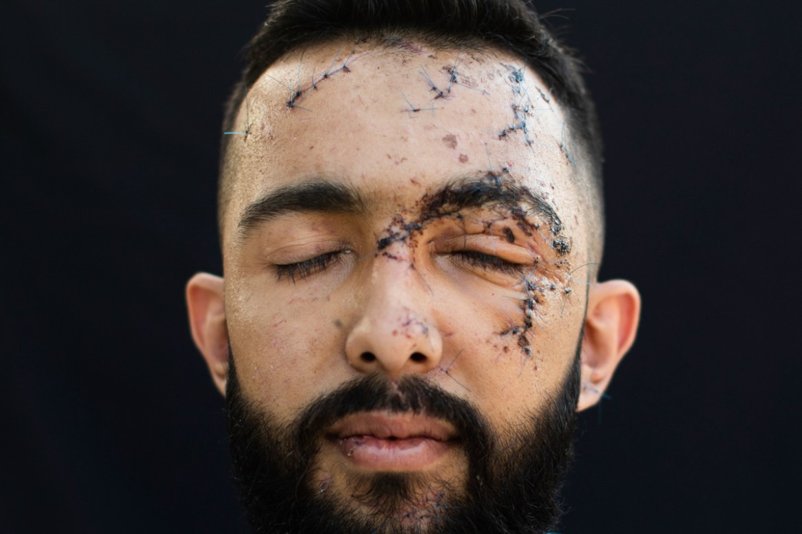 Hussein Haidar, 27, who got injured at his office during the Aug. 4 explosion that killed more than 170 people, injured thousands and caused widespread destruction, poses for a photograph at his paren