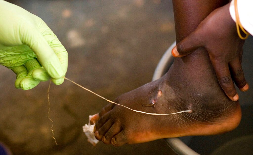 Guinea worm cases drop to 14 – close to Jimmy Carter’s goal of 0