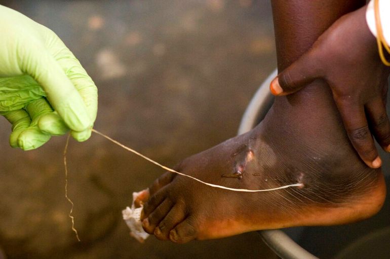 In this 2007 file photo, a Guinea worm is extracted by a health worker from a child's foot at a containment center in Ghana.