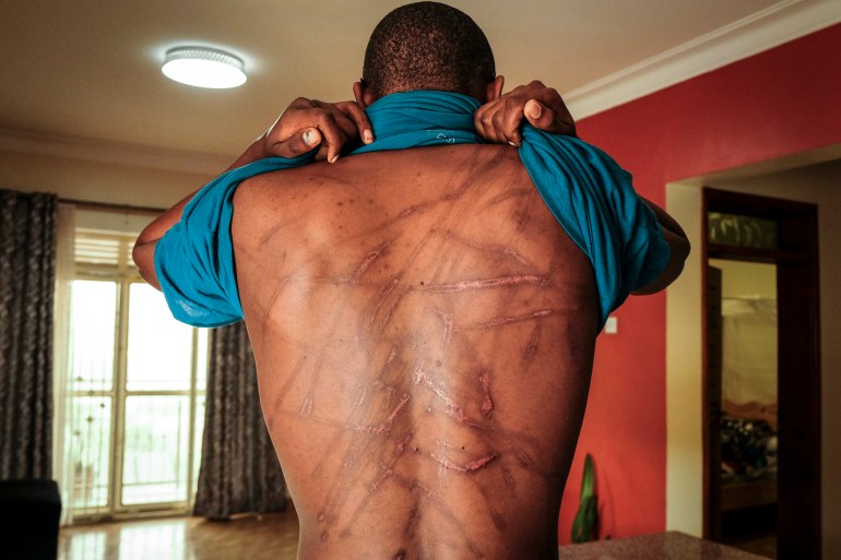 Ugandan writer Kakwenza Rukirabashaija displays scars on his back that he claims were inflicted while he was tortured for weeks in detention