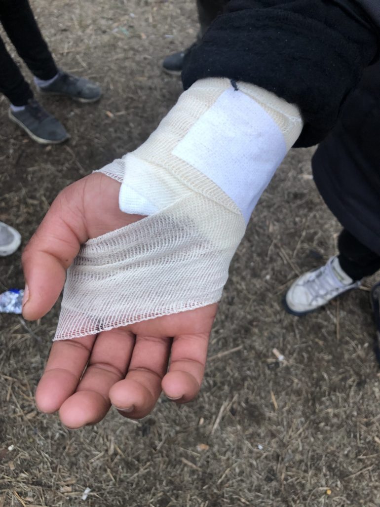 A bandaged hand of a migrant man in Serbia