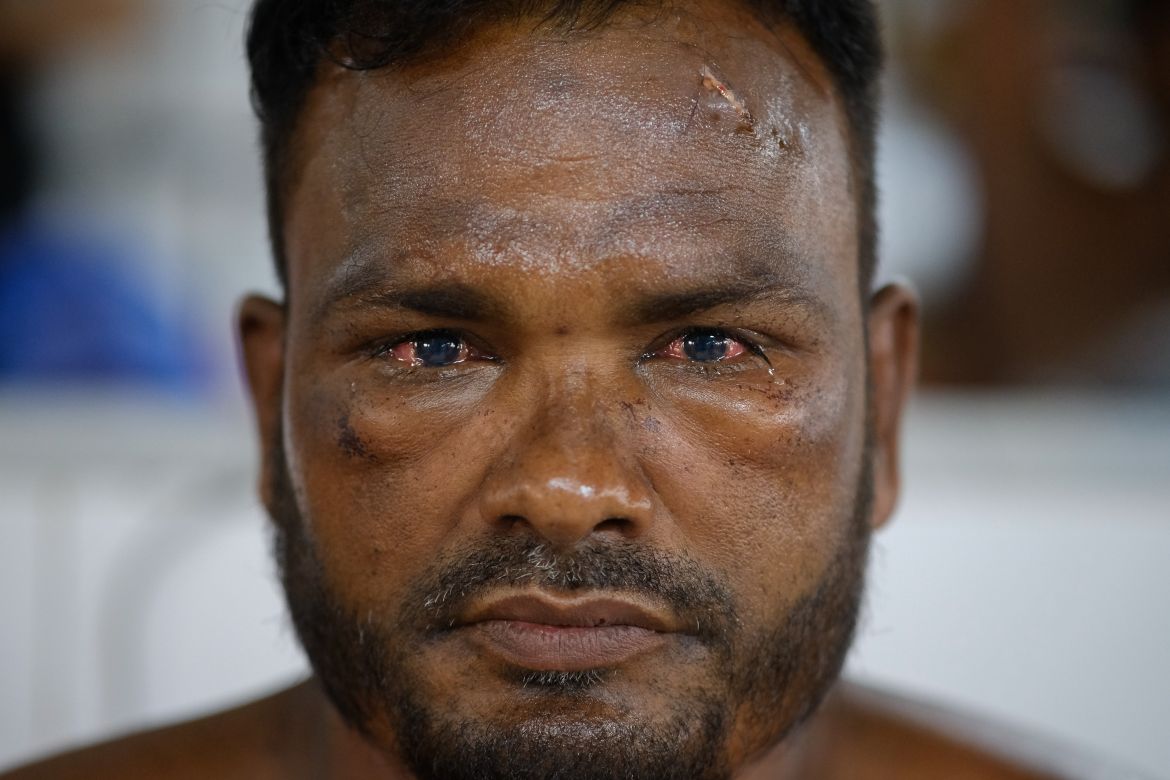 Nur Mohammad suffers eye injuries after the fire and explosion at BM Container Depot at Sitakunda in Chittagong.