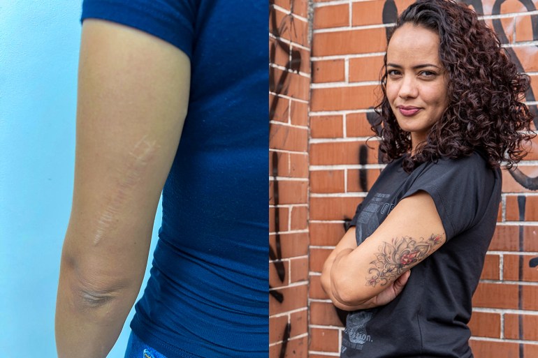 Souza showing some of her scars that were covered by the tattoo