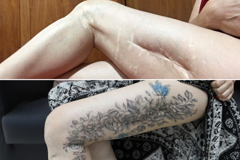 Womans with scars on thigh covered up by tattoo