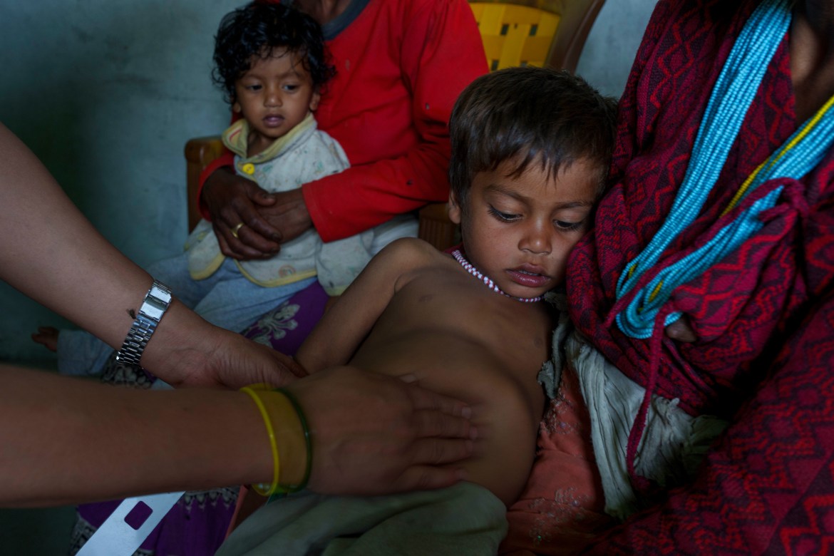A Health worker inspect a swollen stomach of a malnourished child