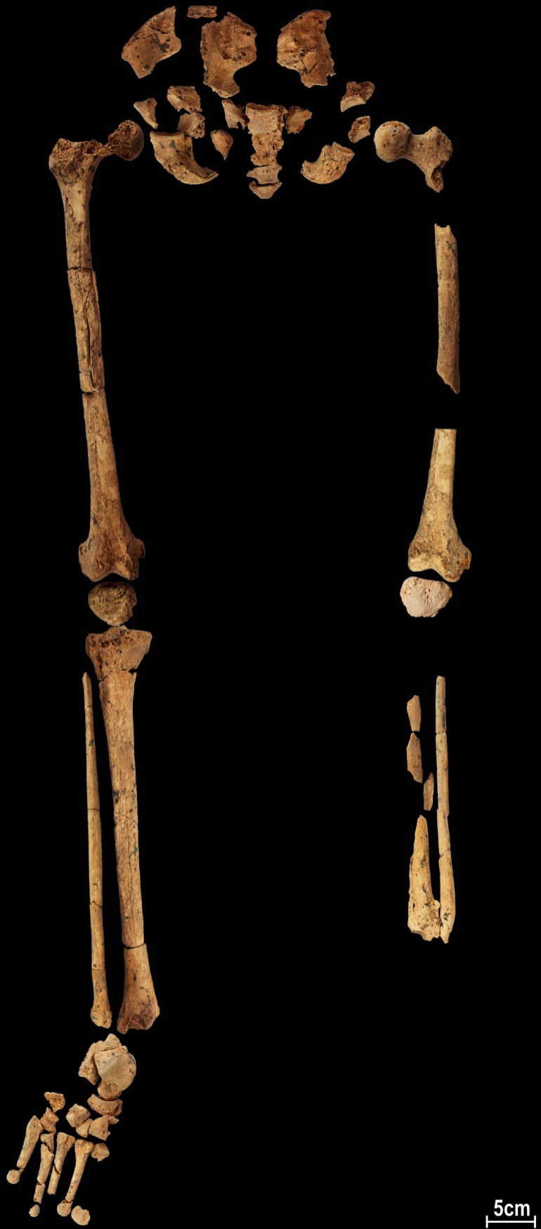 Borneo skeleton might present 31,000 yr previous amputation | Science and Expertise Information