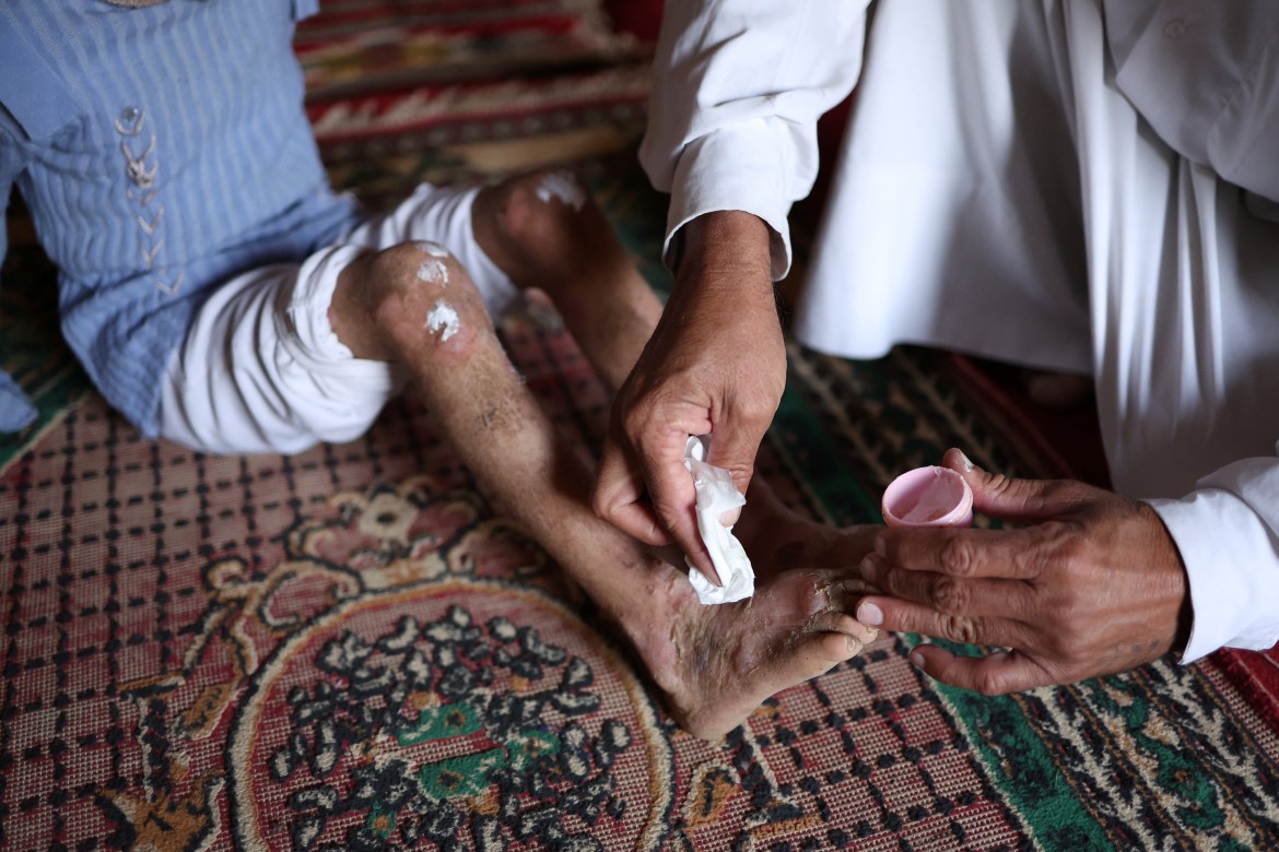 Kazem Hussain, 52, applies ointment to the legs of his niece.