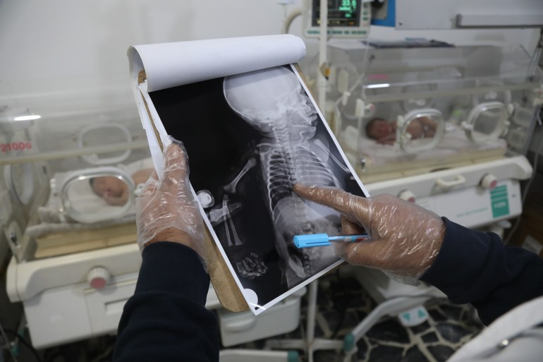 A doctor looks at x-rays near baby Aya's incubator