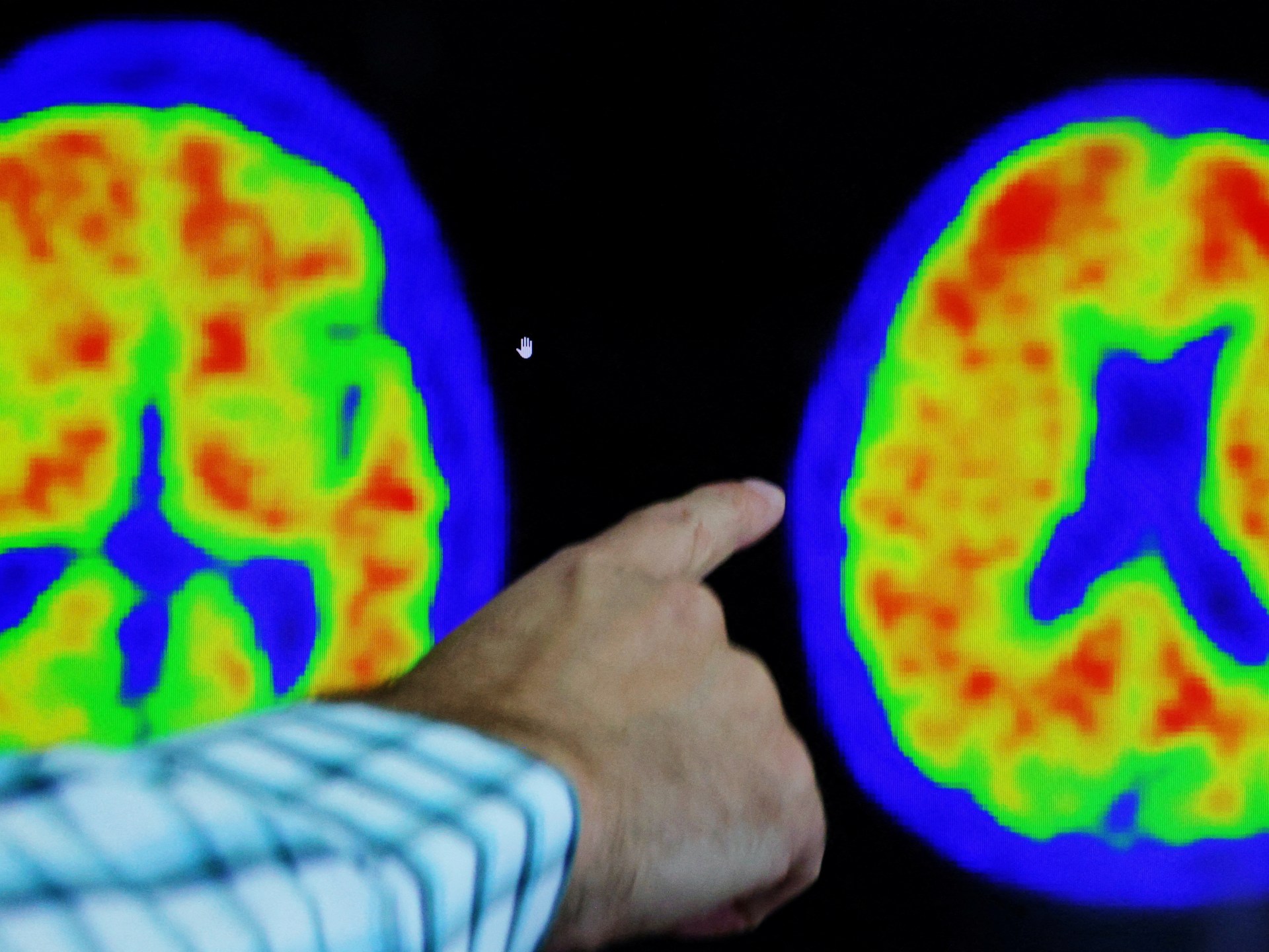 Obat ‘Luar Biasa’ Memperlambat Penurunan Alzheimer, Studi Menunjukkan |  Berita Kesehatan