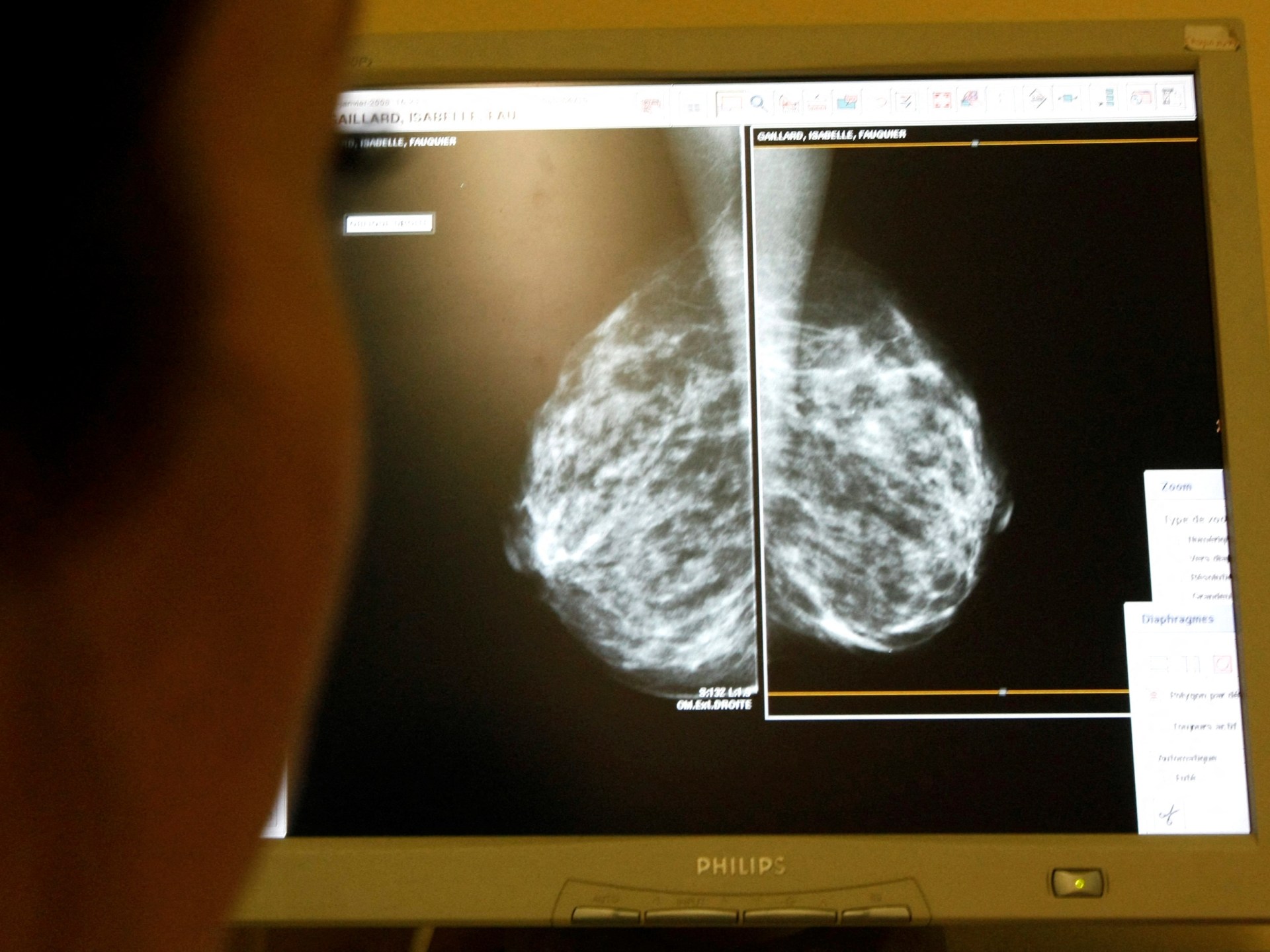 Panel AS merekomendasikan skrining kanker payudara harus dimulai pada usia 40 |  Berita Kesehatan