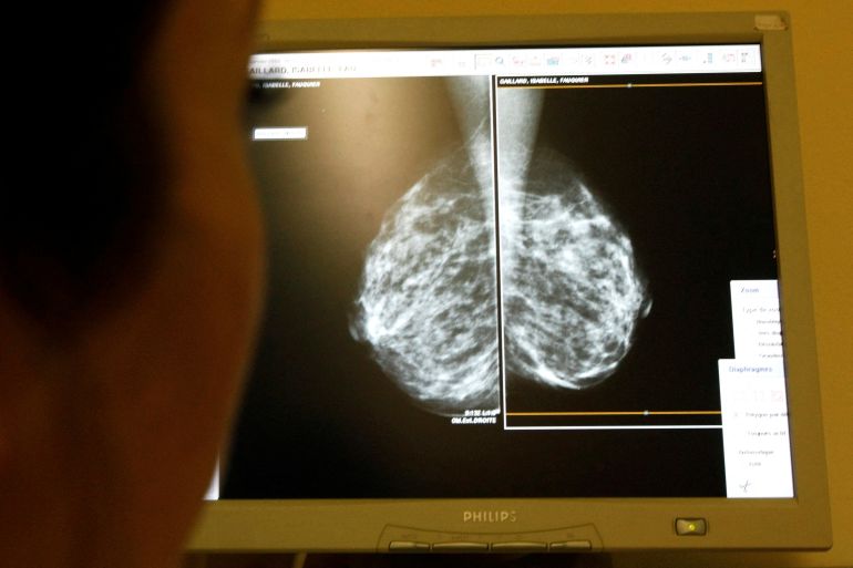 A doctor examines a mammogram image