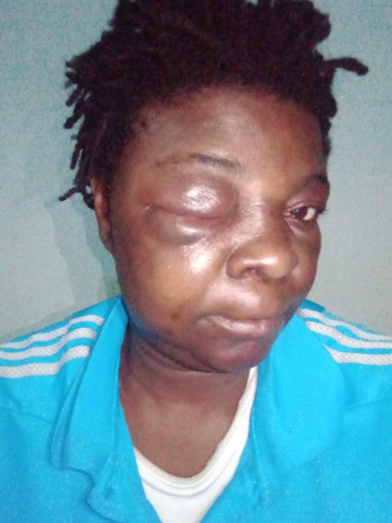 A woman beaten until her eye is swollen shut looks at the camera out of her other eye