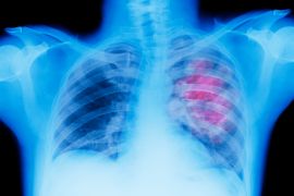 The treatment osimertinib was shown to halve the risk of death from a certain type of lung cancer [File: Getty Images]