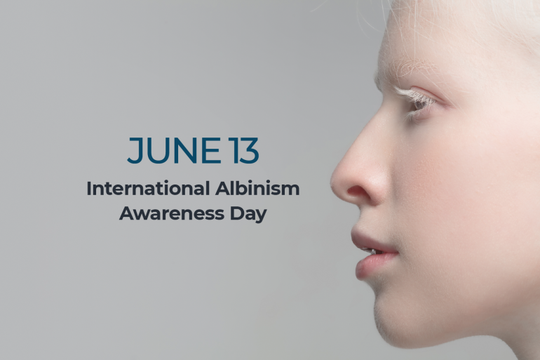 INTERACTIVE Albinism awareness day-1686631767