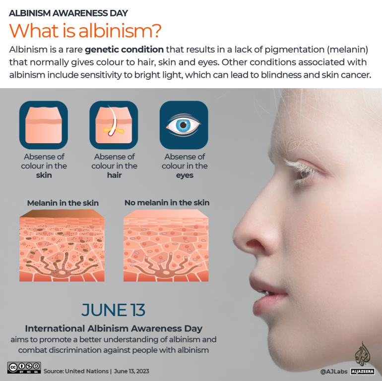 INTERACTIVE Albinism awareness day - whatis albinism-1686631760