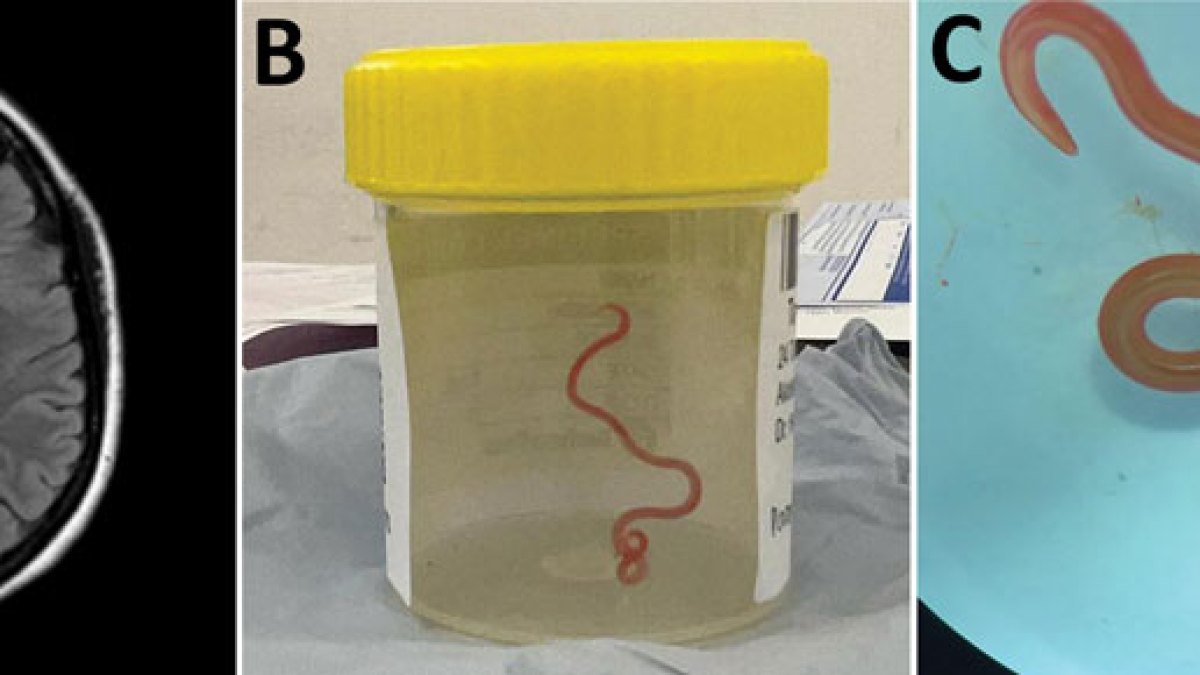 Por primera vez en el mundo se encontró un gusano parásito vivo en el cerebro de una mujer australiana |  Noticias de Salud