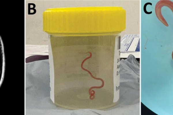 Жив паразитен червей е открит в мозъка на 64 годишна