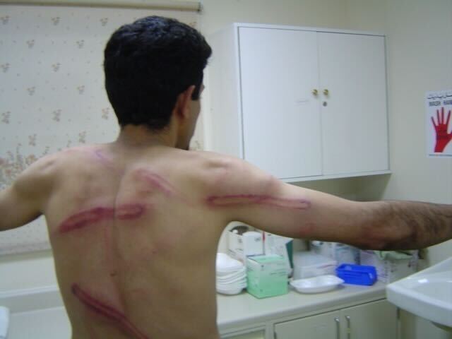 The injuries sustained by Abdulhadi al-Khawaja while imprisoned 