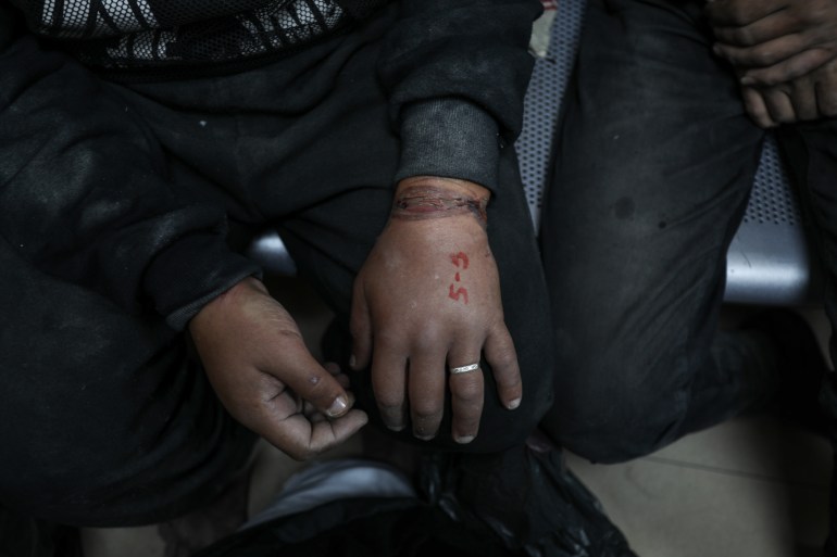 One of the Palestinian men arrested and tortured for days by Israeli soldiers shows the number he was marked by, and his swollen hand from the handcuffs 