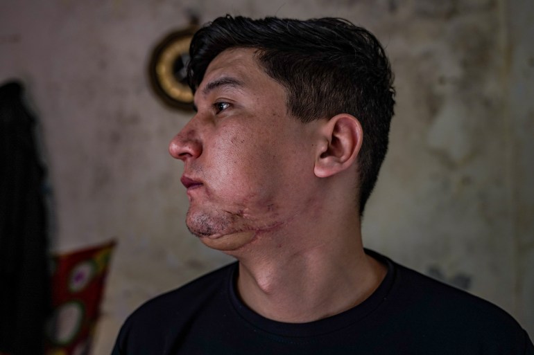 Bullets had pierced through Marzai’s chin in the Taliban attack. Photo by Luqmaan Zeerak.