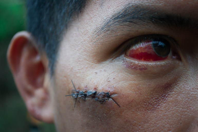 A protestor in Palo Quemado shows his wound.