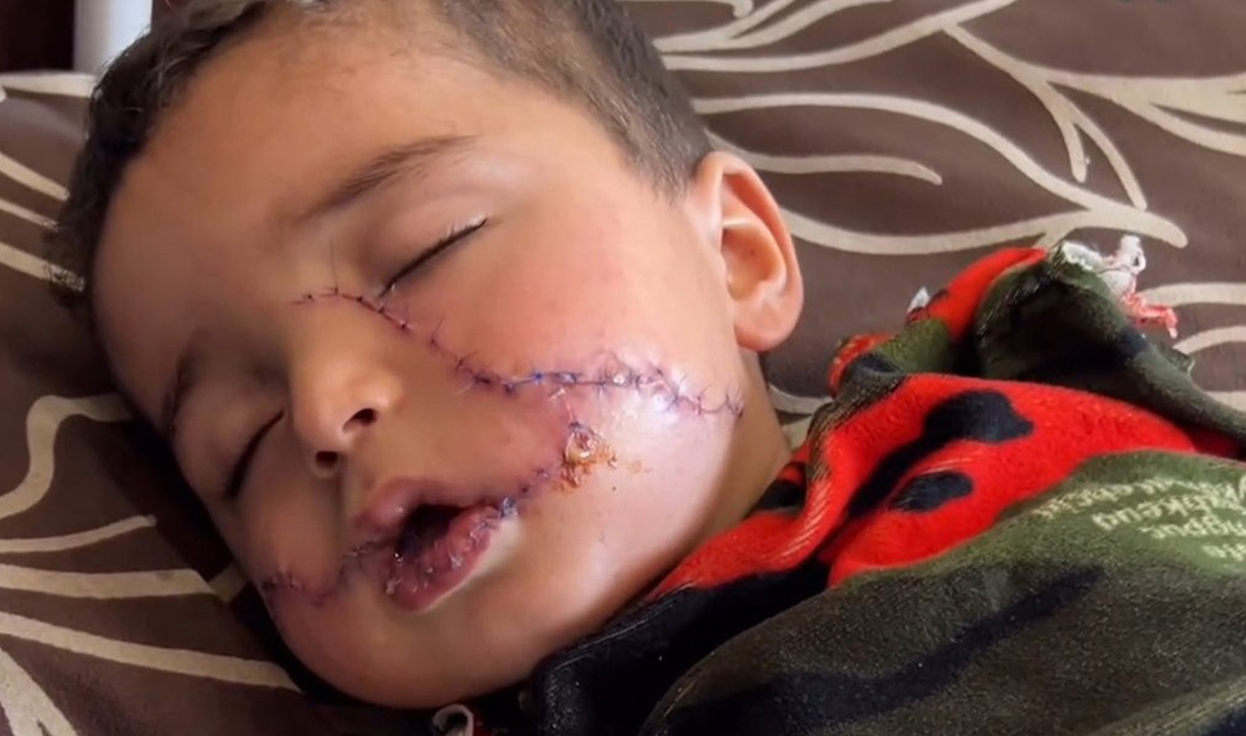 Injured Gaza 1-year-old suffers 200 facial stitches and hand amputation